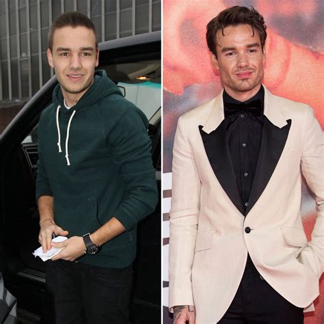 Did Liam Payne Get Plastic Surgery? Jaw, Face Photos | Life & Style