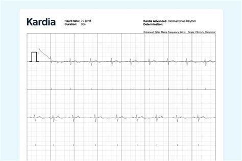 What Sinus Rhythm Looks Like on Your Watch ECG | Qaly