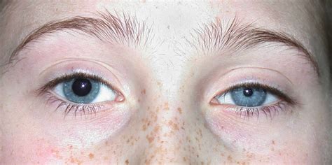 Anisocoria causes, anisocoria in babies causes, diagnosis and treatment