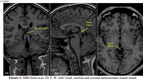[PDF] Estimation of Pineal Gland Volume for Normal Adult Sudanese Using MRI | Semantic Scholar