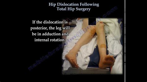 dislocation following total hip replacement causes and cures - raymundoroegner-99