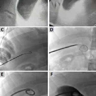 (A).Necessary table for cholecystostomy procedure. (B). Identified... | Download Scientific Diagram