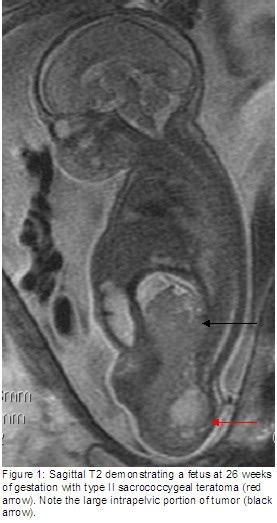 📃 Sacrococcygeal teratoma