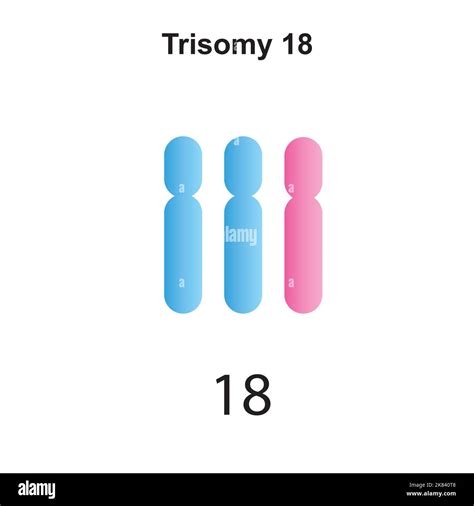 Scientific Designing of Edwards Syndrome (Trisomy 18). Colorful Symbols ...