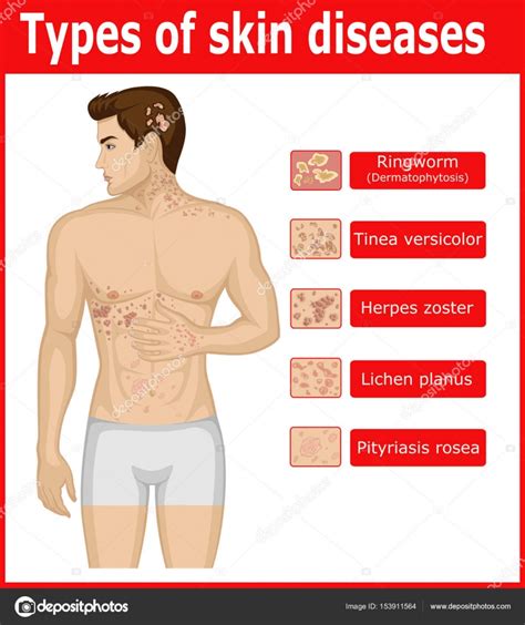 Types of skin diseases Stock Vector Image by ©scio21.ukr.net #153911564