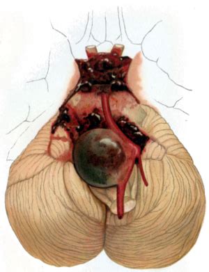 Intracranial aneurysm - Wikipedia