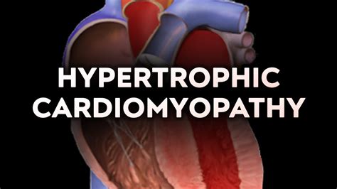 Hypertrophic Obstructive Cardiomyopathy (HOCM) - YouTube