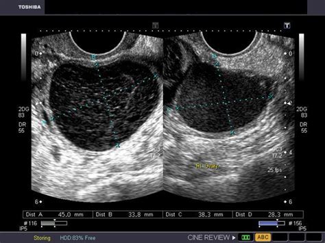 A Gallery of High-Resolution, Ultrasound, Color Doppler & 3D Images - ovaries