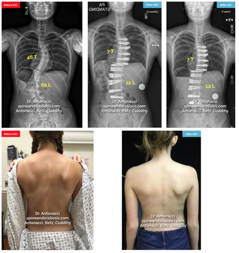 Scoliosis Surgery Before and After