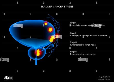 Bladder cancer stages, illustration Stock Photo - Alamy