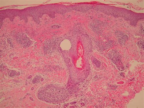 Granulomatous Rosacea (Granulomatous Facial Dermatitis, Lupoid Rosacea) - The Clinical Advisor