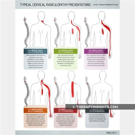 Typical Cervical Radiculopathy Presentations Printable Handouts For ...