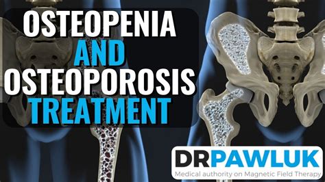 Osteopenia and Osteoporosis Treatment with PEMFs (Electromagnetic Stimulation) - YouTube