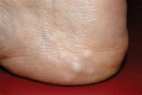 Help with your feet: Piezogenic Papules