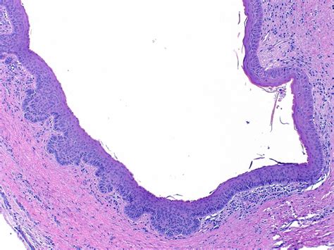 Odontogenic Keratocyst Histology