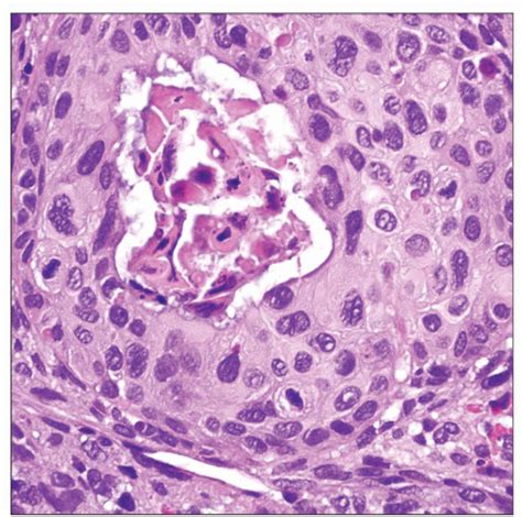 Thymic Carcinoma | Basicmedical Key