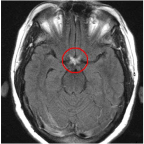 MRI of a patient with NMO showing inflammation (circled in red) of both optic nerves as they ...