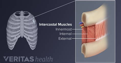 Upper Back Pain from Intercostal Muscle Strain