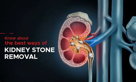 Guide on Kidney Stone Removal Process | Laser Treatment - PSRI Hospital