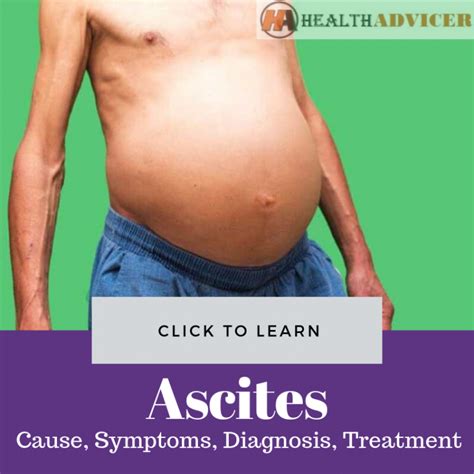 Ascites In Nephrotic Syndrome