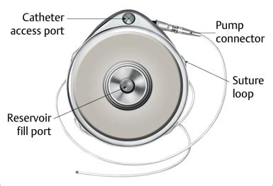 18 Baclofen Pump/Morphine Pump | Neupsy Key