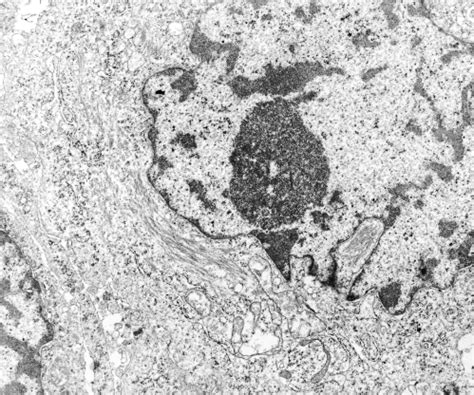 Case 1, abdominal mass. Transmission electron microscopy; uranyl... | Download Scientific Diagram