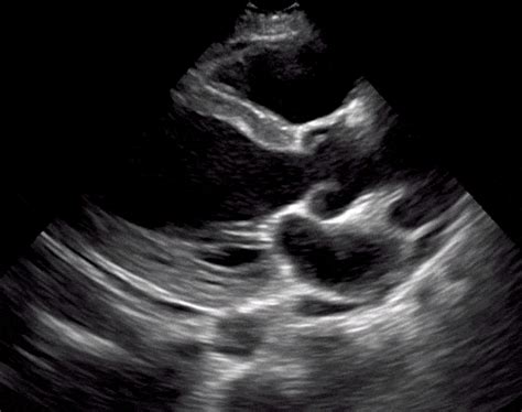 Echocardiography Ejection Fraction