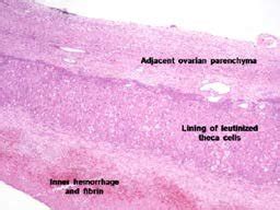 Microscopic examination of cyst wall showing luteinized theca cells (H ...