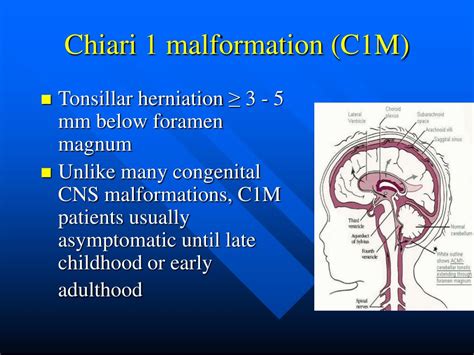 PPT - Chiari 1 Malformation presenting as “ Strabismus of obscure cause” PowerPoint Presentation ...