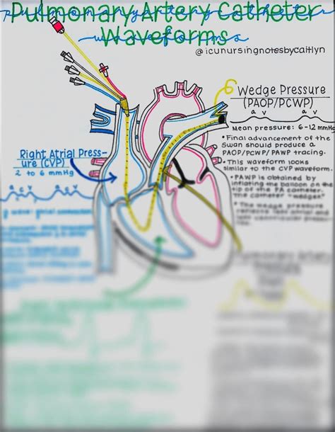 Hemodynamic/swan-ganz Catheter Waveforms - Etsy