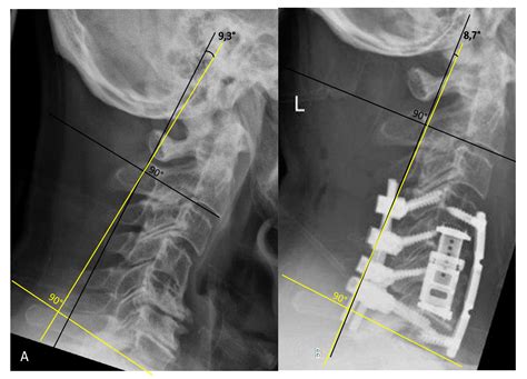 Medicina | Free Full-Text | Application of an Expandable Cage for ...