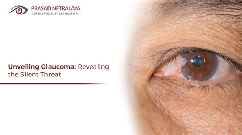 Unveiling Glaucoma: Revealing the Silent Threat