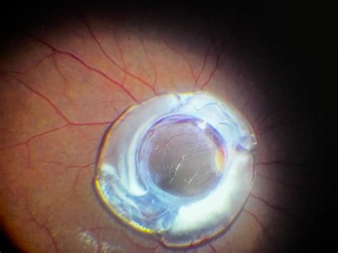 Blog Intraocular Lens Dislocation - Prime Retina Eye Care Centre - Best Eye Hospital in ...