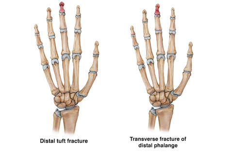 Finger fractures