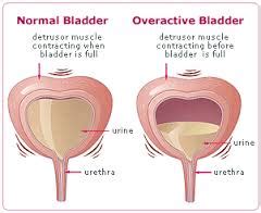 Overactive bladder | Oxford Urology Associates