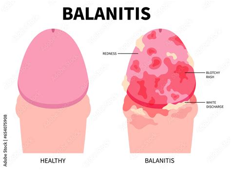 The Candida fungal bacteria infected to skin that cause inflammation ...