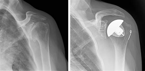 Shoulder Joint Replacement - OrthoInfo - AAOS