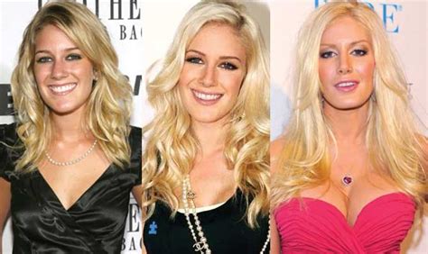 Heidi Montag Plastic Surgery Before and After Pictures 2024