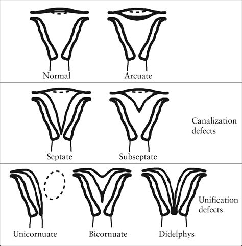 Outcome of assisted reproduction in women with congenital uterine ...