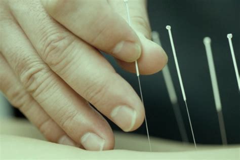 Acupuncture for Effective Weight Loss | Medical Acupuncture