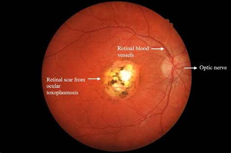 Ocular Toxoplasmosis | Plano | Save sight. Empower lives.