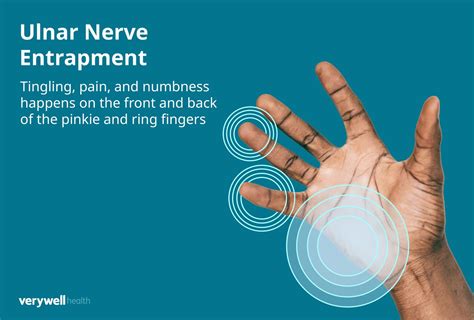 Ulnar nerve compression, ulnar nerve entrapment - plantecuador.com