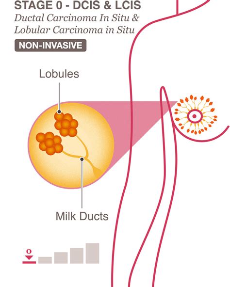 Stage 1 Breast Cancer Treatment - CancerWalls