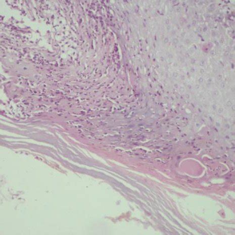 (PDF) Infantile acropustulosis: a case report