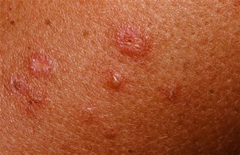 Dermatitis herpetiformis causes, symptoms, diagnosis and treatment