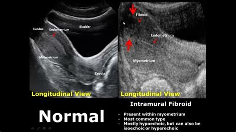 Uterus Ultrasound Normal Vs Abnormal Image Appearances Comparison | Uterine Pathologies USG ...