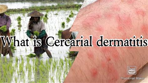 CERCARIAL DERMATITIS - YouTube