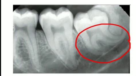 "DILACERATION" DEVELOMENTAL DISTURBANCE OF TEETH# QUICK RECAP FOR DENTAL STUDENTS - YouTube