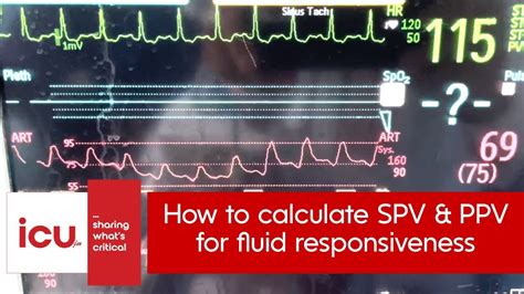 How to calculate SPV and PPV and how to use them for accessing fluid responsiveness in ICU - YouTube