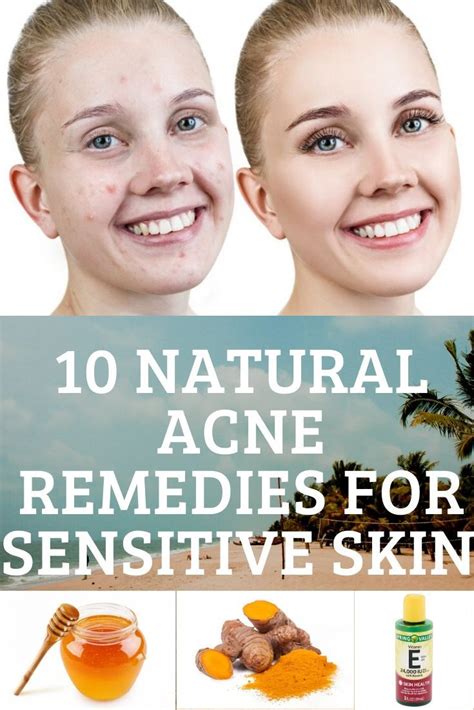 10 NATURAL ACNE REMEDIES FOR SENSITIVE SKIN BAKING SODA in 2020 | Sensitive skin remedies ...